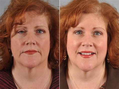  · A <strong>Picture</strong> is Worth a Thousand Words. . Droopy eyelid surgery before and after pictures